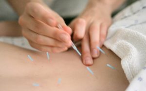 Dry Needling - Action Sports Clinic