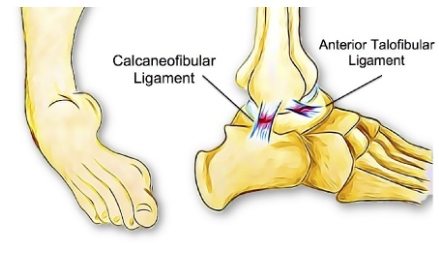chronic ankle instability