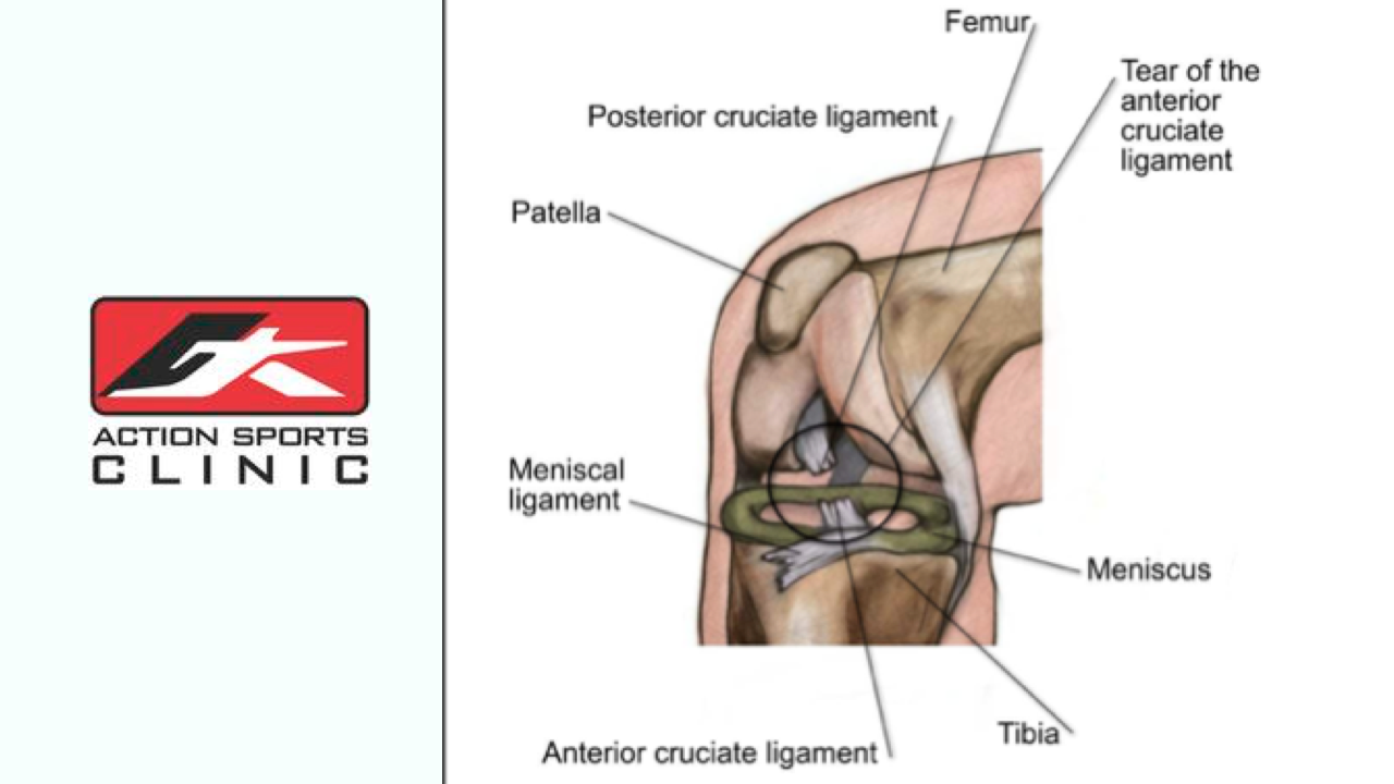 Physio Calgary - ACL Injury Featured Image
